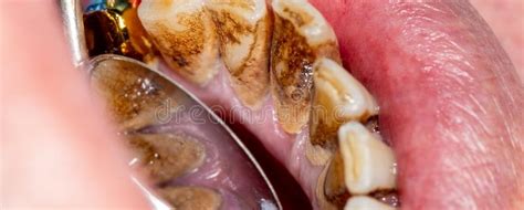 Calculus: how it is formed, how to remove it and how to prevent it - EZZA DENTAL CARE