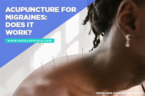 Acupuncture for Migraines: Does It Work? | Oriole Physiotherapy & Rehabilitation Center