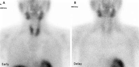 99mTc-MIBI scan. No significant uptake was observed in either the early... | Download Scientific ...