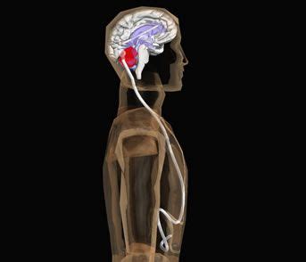 Pin on Pseudotumor Cerebri