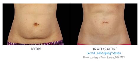 CoolSculpting Delray Beach, FL | Delray Dermatology + Cosmetic Center