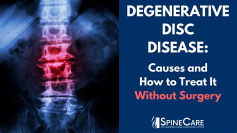 DEGENERATIVE DISC DISEASE: Causes and Non-Surgical Treatments