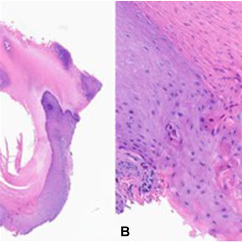 Porokeratosis Pictures Types Causes Treatment