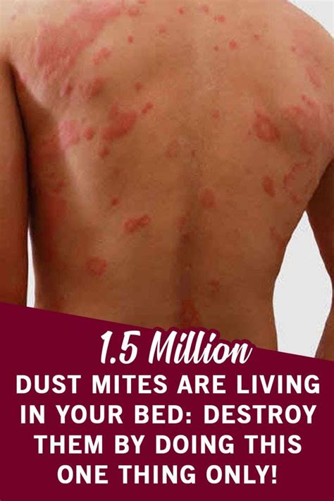 67 Amazing Mites Symptoms Humans - insectza