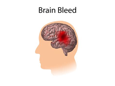 UAB joins study to slow bleeding in the brain - News | UAB