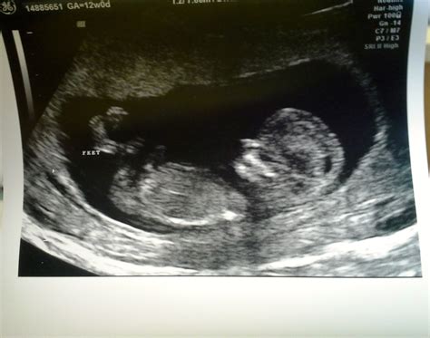 Unexpectedly Expecting Baby: Nuchal Scan and 12-Week Ultrasound Pics!