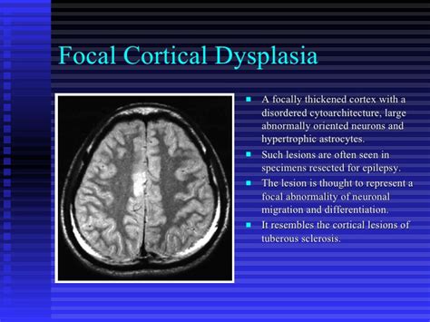 What Is Cortical Dysplasia? | EpilepsyU