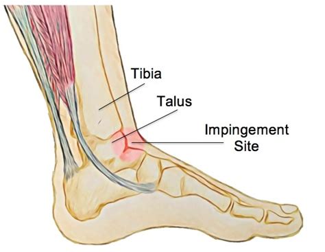 Anterior Ankle Impingement - Rural Physio at Your Doorstep