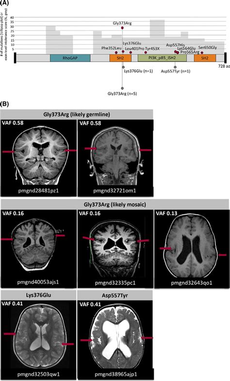 Diverse genetic causes of polymicrogyria with epilepsy. - Abstract - Europe PMC