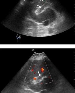 Ultrasound of Portal Vein Thrombosis - SIFSOF