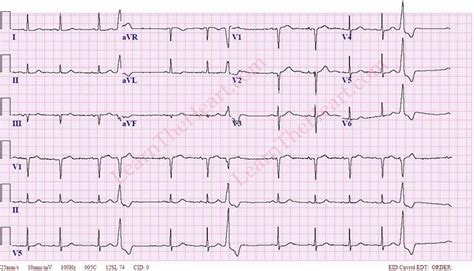 Premature Ventricular Contractions (PVCs) ECG (Example 2) | Learn the Heart