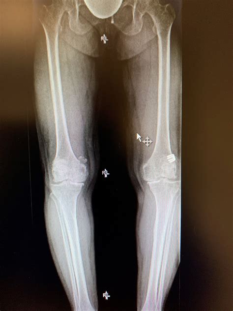 Case Study: Bilateral Knee replacement in 54 yr. Old Female