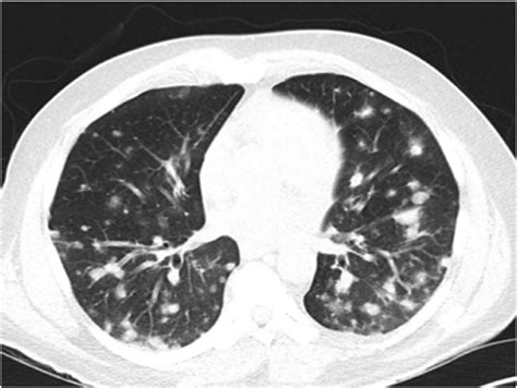 Chest CT scan on admission showing bilateral pulmonary nodules. | Download Scientific Diagram