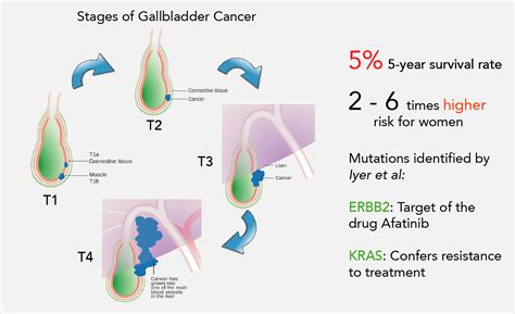 Towards personalized therapy for Indian gallbladder cancer patients ...