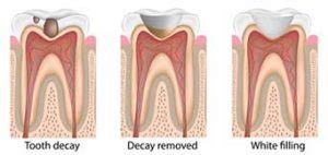 Difference Between A Dental Filling And A Dental Crown | Dentist ...