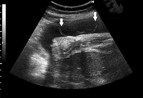 Prenatal Diagnosis of Amniotic Band Syndrome in the Third Trimester of Pregnancy using 3D ...