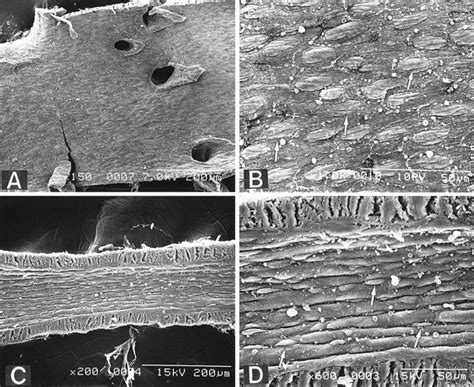 Images of Vasospasm – Peripheral Brain