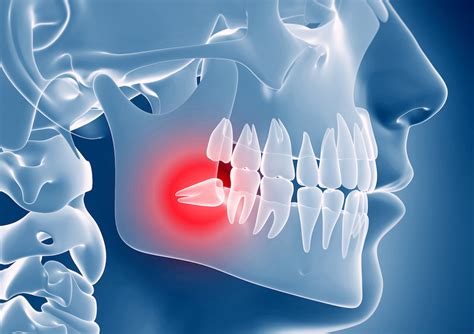 Impacted Wisdom Teeth | Dr. Sandeep Dhesi | Oral and Maxillofacial Surgery | Calgary, AB