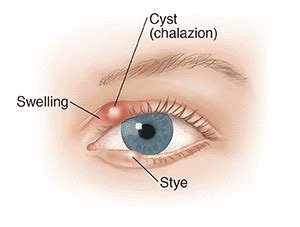 Chalazion and Stye | MA | Eye Physicians of Northampton