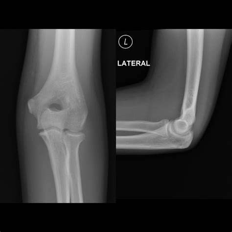 Elbow X Ray Fracture