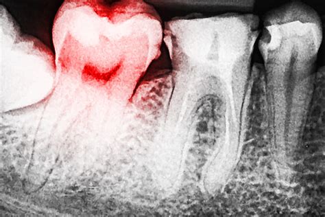 Facts About Exposed Tooth Root Pain | veinscny.com