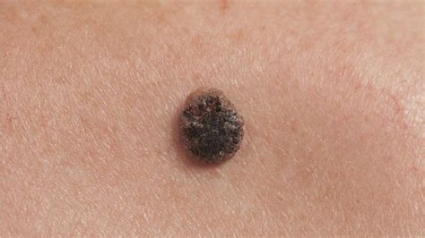 What is malignant melanoma and how do you treat it? - BBC News