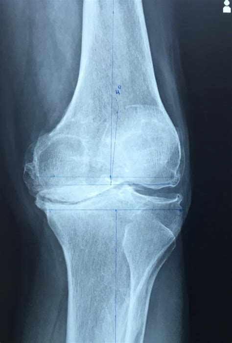 Artrosis de rodilla – Dr. Luis Calderón S.