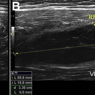 Postoperative ultrasound evaluation of the hematoma. (A) Short-axis ...