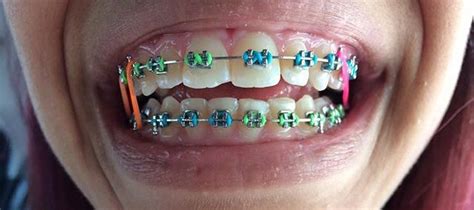 braces colors girls – Braces Explained