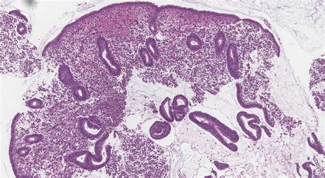 Proliferative endometrium | Ottawa Atlas of Pathology