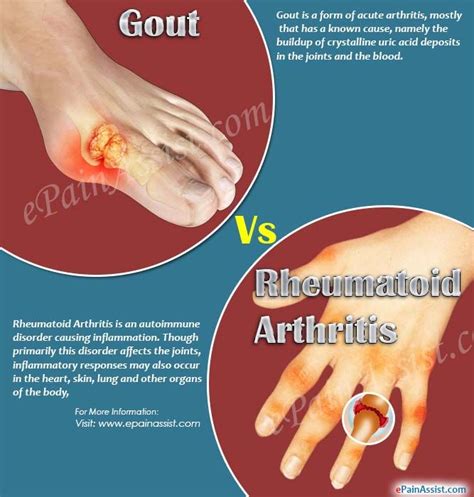 Gout Vs Rheumatoid Arthritis | Rheumatoid arthritis, Gout, Gout symptoms