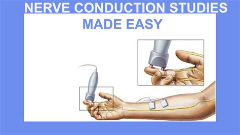 Nerve Conduction Study Video