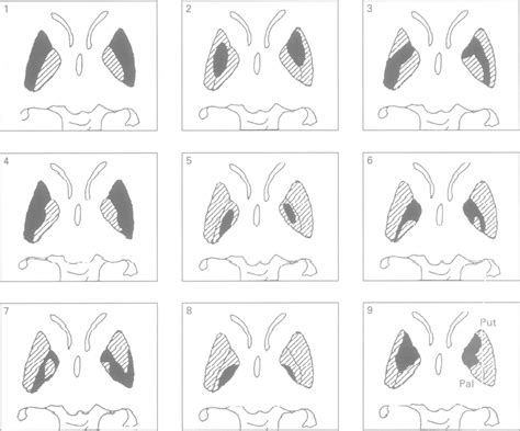 Schematic representation of the lentiform nucleus lesions in the nine ...