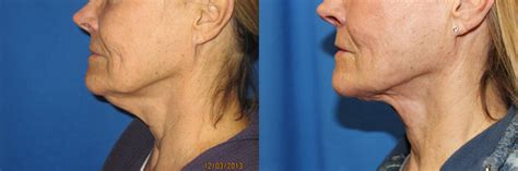 Laser Skin Rejuvenation Before & After Pictures Case 49 – Coeur d'Alene ...