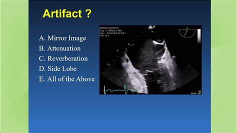 Fundamentals of Echo Artifacts - YouTube