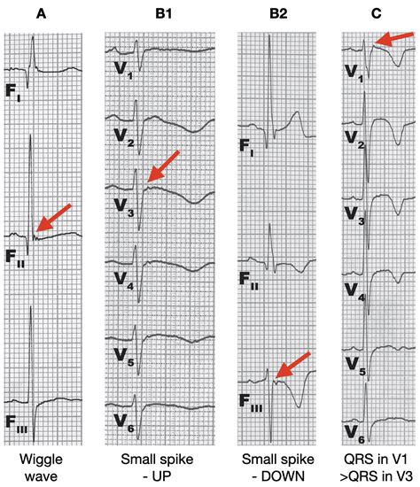 Epsilon Wave • LITFL Medical Blog • ECG Library Basics