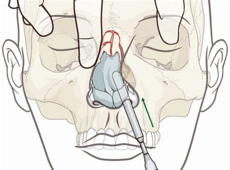 Nasal Fractures - Causes, Symptoms, Diagnosis, Treatment