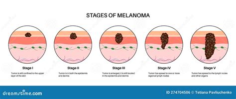 The Stage III Melanoma Tumors Stock Photo | CartoonDealer.com #281924052