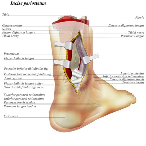 Ankle Posterolateral Approach - Approaches - Orthobullets