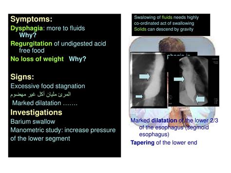 PPT - Diseases of the esophagus PowerPoint Presentation, free download - ID:1012308