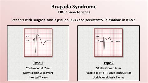 Brugada Syndrome