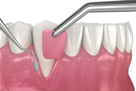 How Long Does Swelling Last After Gum Graft Surgery? | TOTAL IMPLANTS & PERIODONTICS