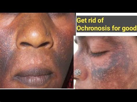 How To Treat Ochronosis | Causes Of Ochronosis and Prevention - YouTube