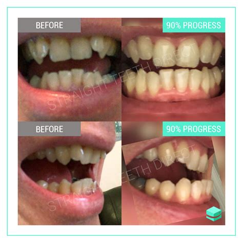 How To Clean Smile Direct Aligners - Find Property to Rent