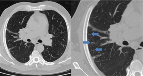 Thorax CT scan: muliple peripherical centrilobular nodules with... | Download Scientific Diagram