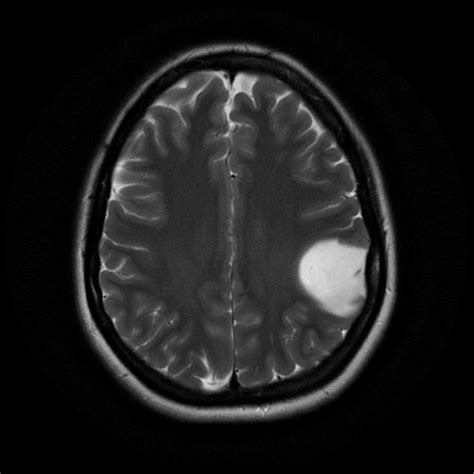 Astrocytoma MRI - wikidoc