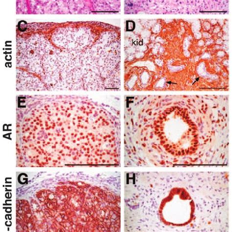 Neoplastic progression of high-grade PIN lesions from Nkx3.1 ϩ / Ϫ ;... | Download Scientific ...