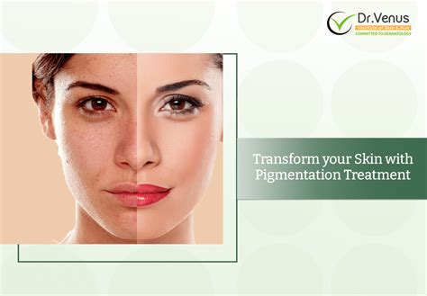 Freckles to Fabulous: Transform your Skin with Pigmentation Treatment ...