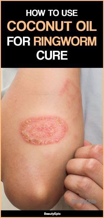 Home remedies for ringworm - polizshoe