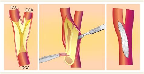 Figure 1 from Carotid artery stenting vs. endarterectomy. | Semantic Scholar